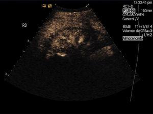 Doppler Ultrasound showing a 2–3mm thick hypoecogenic halo diffuse and concentric marking the cortical; the rest including medullary pyramids an renal sinus is preserved.