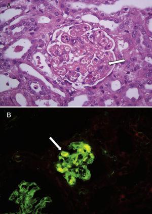 Findings from the renal histology of one child with diarrhoea-positive haemolytic uraemic syndrome with no thrombocytopenia. (A) Renal glomeruli with capillary dilatation and mesangiolysis (white arrow). Haematoxylin and eosin, 400×. (B) Immunofluorescence showed fibrin thrombi in some glomeruli (white arrow), 400×.