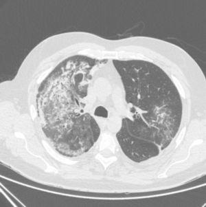 Image of high-resolution chest CT scan revealing an alveolar pattern compatible with pulmonary haemorrhage.