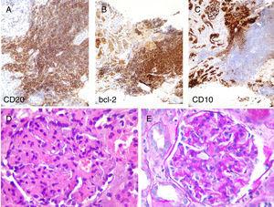 The lymphoid population expressed CD20 and bcl-2, with negative staining for CD10 and other B lymphoid lineage markers. (A–C: immunohistochemistry technique indicated in figure, ×20). In preserved normal renal parenchyma, it can see lobular glomeruli with increased matrix and, to a lesser extent some mesangial cellularity with occasional images of endocapillary proliferation (D: H&E, ×40; E: PAS-diastase, ×40).