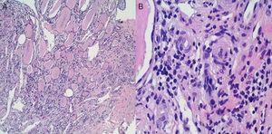 (A) Clear histological signs of chronic interstitial kidney disease characterised by tubular dilation rich in material with a colloid-like appearance offering a typical picture of “renal thyroidisation”. (B) In small vessels and the medullary region, myointimal proliferation is observed with luminal occlusion and initial middle-layer proliferation with incipient “onion-layer” formation.