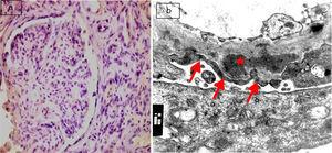 (a) Active lupus nephritis ISN/RPS class V (A), NIH activity index (12/24) NIH chronicity index (4/12) showing negative immunostaining for podocalyxin (original magnification ×400). (b) An electron micrograph for the same case showing marked diffuse fusion of podocyte foot processes (arrows) and subepithelial electron dense deposits (asterisks) (negative magnification ×22,000).
