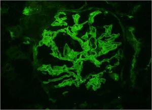 Immunofluorescence microscopy: intense linear staining along the glomerular capillary loops for IgA (×400).