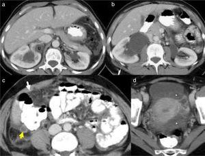 CT: (a and b) bilateral hydronephrosis, grade 2 on the right and grade 3 on the left; (c and d) dilation of the distal ureter (U). Linear enlargement with increased uptake in some areas of the parietal peritoneum (arrow) and mesenteric infiltration. Moderate septated ascites in the pelvis (*). Tubular structure adjacent to the caecum related to the appendiceal mucinous tumour (arrow).