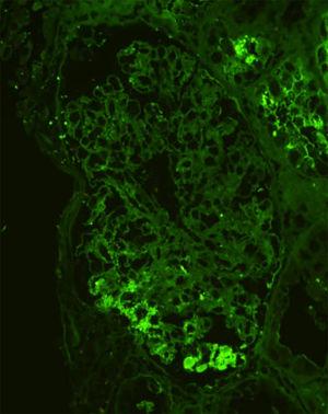Renal biopsy (IgA immunofluorescence, ×400), showing bright and coarsely granular staining in the glomeruli.