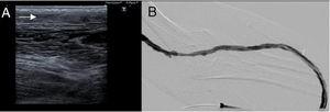 Loop-type left forearm humerocephalic prosthesis. (A) Doppler ultrasound showing intravascular echogenicity in relation to graft thrombosis. (B) Post-thrombectomy angiography performed from the arterial end of the loop, demonstrating permeability of the graft.