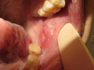 Clinical photograph shows 1 minor aphthous ulcer, on buccal mucosa.