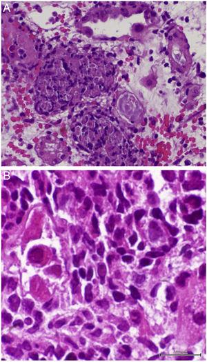 Light microscopy shows (A) interstitial nephritis and ill-defined granuloma formation surrounding tubules (hematoxylin and eosin stain; original magnification, 40×) and (B) intranuclear viral inclusion (hematoxylin and eosin stain; original magnification, 60×).