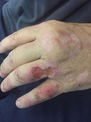 Lesions on the back of the left hand.