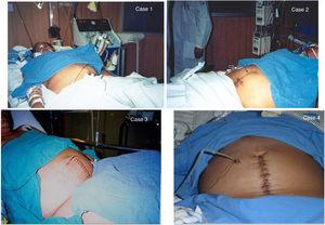 Images of the 4 pre-eclamptic patients with acute kidney injury treated with a rigid peritoneal dialysis catheter in the surgical puerperium.