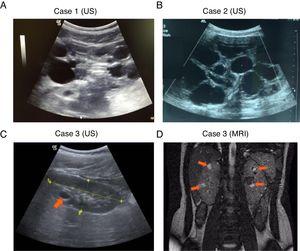 Renal image studies in the three TSC patients. (A and B) Polycystic kidney disease detected by US in cases 1 and 2. (C) Single cyst in the right kidney detected by US in case 3 (arrows). (D) Polycystic kidney disease detected by MRI in case 3.