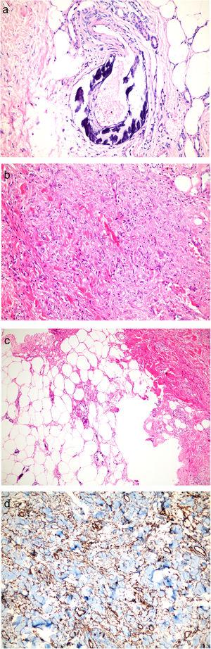 Histopathological examinations. (a) Lesions on legs: Dermal and subcutaneous arteriolar calcification and narrowing of the vascular lumen in subcutaneous tissue (HE stain; original magnification ×200). (b, c) Lesions on infraumblical region: Spindle cell proliferation, focal sclerosis, thick collagen bundles in dermis, fibrous thickening of the septum in subcutaneous tissue and subcutaneous arteriolar calcification (HE stain; original magnification ×40 and ×200 respectively). (d) CD34 positivity.