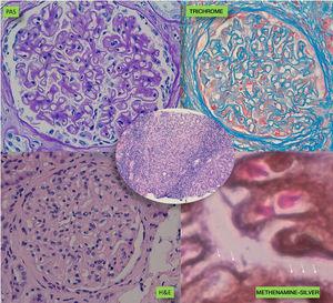 Optical microscopy images of the kidney biopsy.