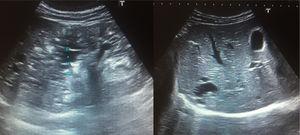 Renal and liver ultrasound with the presence of cysts in the symptomatic patient.