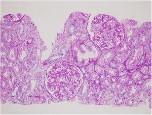 Renal biopsy which display glomeruli with basal membrane thickening and enhanced mesangial matrix H.E. ×200.