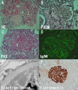 Light microscopic, immunofluorescence and electron studies. (A) Sclerotic glomeruli (HE). (B) Lobular appearance with cellular mesangial nodules (PASM). (C) Moderate to severe mesangial hypercellularity (PAS). (D) Faint staining for IgM (Immunofluorescence). (E) Massive electron-dense deposits. (F) Fibronectin was strongly positive (immunohistochemistry).