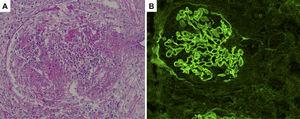 Histological sections of renal biopsy specimens. (A) Periodic acid-Schiff staining showing a cellular crescent formation (original magnification ×400). (B) Immunofluorescence staining showing linear patterns of IgG deposition along the glomerular basement membrane (original magnification ×400).
