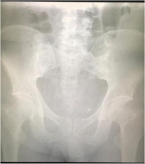 Plain (anteroposterior oblique) radiograph of the sacroiliac joint, showing ankylosis, pseudo-widening, and subchondral sclerosis in the right sacroiliac joint (grade 3 sacroiliitis) and subchondral sclerosis pseudo-widening in the left sacroiliac joint (grade 2 sacroiliitis).