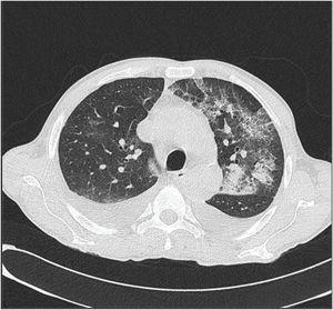 Chest and abdomen computed tomography showing bilateral infiltrates in lungs.