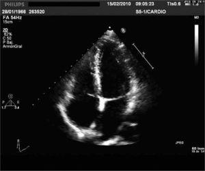 Stayin' Alive: ¿Qué es una ecocardiografía?