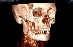 Reconstrucción tridimensional. Ensanchamiento de la cortical externa y erosión ósea de la cresta alveolar en cuarto cuadrante mandibular.