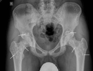 Radiografía anteroposterior de caderas donde se visualizan lesiones escleróticas, simétricas y con bordes bien definidos (flechas).