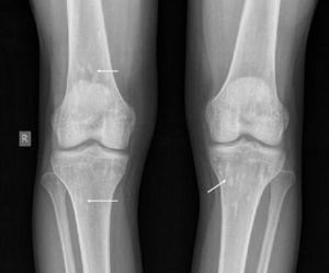 Radiografía anteroposterior de rodillas con presencia de lesiones radiopacas bilaterales de predominio en metáfisis de fémures y tibias (flechas). No hay alteraciones en las relaciones articulares.
