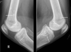 Radiografía con proyección lateral de ambas rodillas con presencia de lesiones escleróticas (flechas) sin evidencia de alteraciones en los tejidos blandos circundantes a los huesos, ni fracturas, ni compromiso de las superficies articulares.