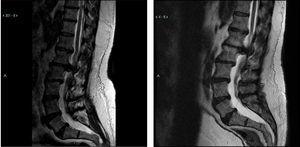 2011 (left) and 2015 (right) MRI sagittal section which revealed a large L1–L2 disk herniation causing significant compression of the thecal sac and conus medularis.
