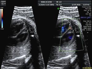 Ecocardiograma prenatal: comunicación interventricular muscular apical pequeña.