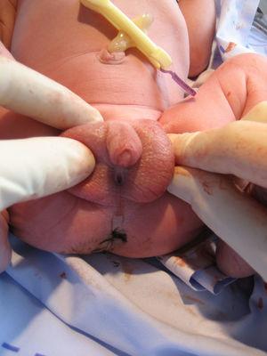 Genitales externos del recién nacido. Ambos testículos en la bolsa escrotal, pene de pequeño tamaño y meato uretral en periné.