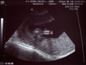Ecografía vaginal, caso 1. La pantorrilla del feto contiene 2 tibias fusionadas.
