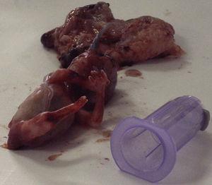 Fotografía fetal del caso 1, tras la evacuación uterina. Se visualiza la extremidad inferior única, con un pie rudimentario.