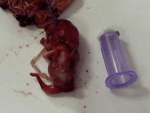 Fotografía fetal del caso 1, espécimen con sirenomelia.