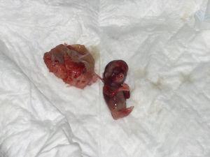 Fotografía del feto perteneciente al caso 2, con extremidades inferiores fusionadas.