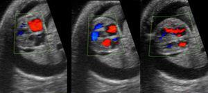 Color-Doppler flow during systolic and diastolic ventricular contraction, observing closure of foramen ovale.