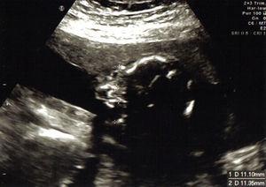 Obstetric ultrasound at 20 weeks; asymmetry of foetal ocular globes.