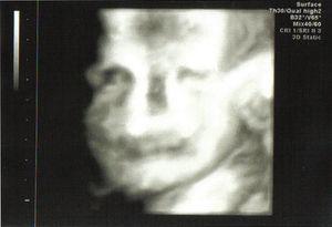 3D ultrasound at 23 weeks; asymmetry of foetal ocular globes.
