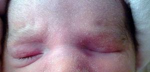 Newborn with left palpebral closure.
