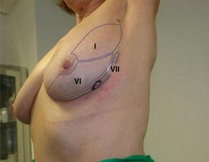 Breast segmentation: lower lateral view exposure of breast segments.