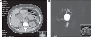 (A) Abdominal CT scan. Saccular dilatation of the bile duct. (B) Cholangiography reconstruction showing cystic dilation of the bile duct (type Ia).