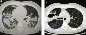 (a) Multiple poorly defined areas of bilateral consolidation with a right predominance, associated with pseudo-nodular images and congestion of both lung hilum. (b) Bilateral, subpleural micronodules and nodule cavitated with hydro-aerial level in the right upper lobe.