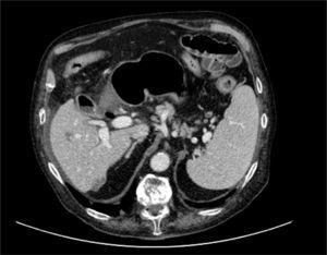 Pneumobilia can be observed in the image with air inside the gall bladder.