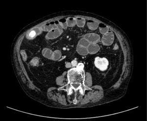 In this image, the gallstone impacted in the affected ileum and the healthy proximal distended bowel loops are visible.