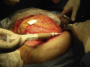 Transgastric drainage of the pseudocyst.