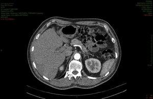 Abdominal and pelvic CT: heterogeneous liver with the presence of ill-defined hypodense focal lesions in the VII and VIII segments (8cm), caudate (2.5cm) and VI and VII (8cm).