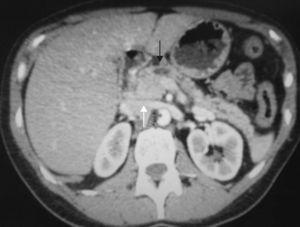 Abdominal CT: dilatation of Wirsung duct (black arrows) up to the pancreatic head which is enlarged, suggesting neoplasia (white arrow).