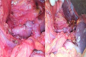 Reconstruction of the superior mesenteric vein resected with interposition of the left renal vein.