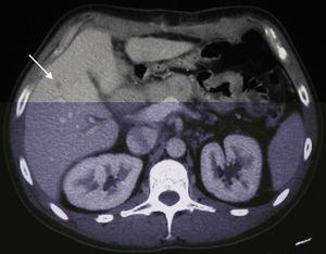Abdominal computed tomography after pancreaticoduodenectomy showing liver metastasis of pancreatic adenocarcinoma (arrow).