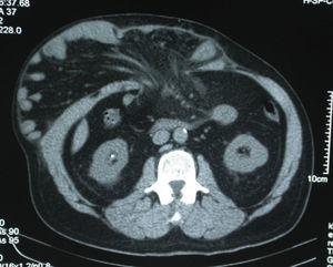 Computed tomography axial cut showing more than 50% of the abdominal content outside the abdomen in the hernial sac.